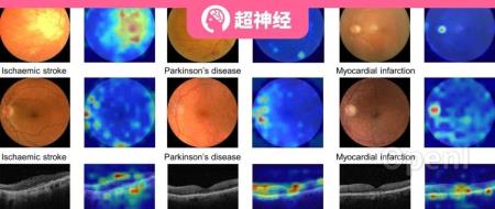 周玉坤团队开发 RETFound 模型，利用未标注的160w+视网膜图像，全方位评估3个维度，预测多种系统性疾病